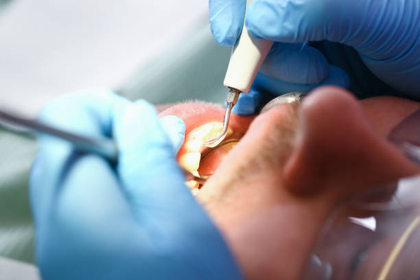 Best Emergency Treatment for Dental Infections or Abscesses in Beacon Square, FL