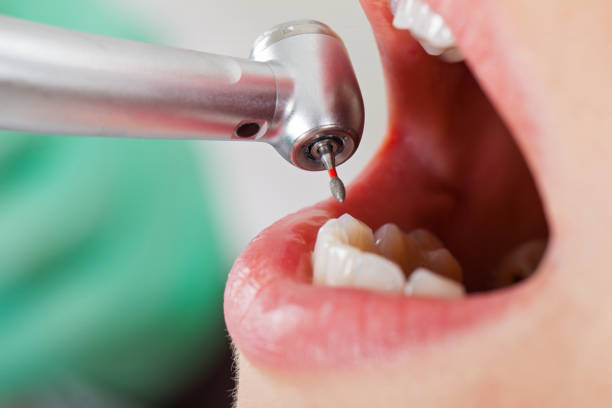 Best Emergency Tooth Extraction in Beacon Square, FL